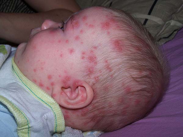 Baby with chickenpox