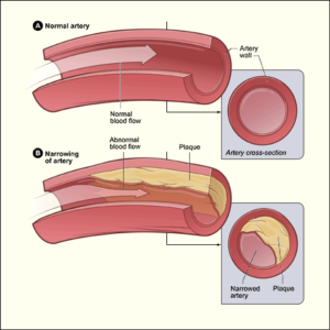 Excess ‘bad’ cholesterol (LDL) can build up on your blood vessel walls causing narrowing/blockages which increase your risk of heart attacks and strokes.