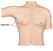 lipoma