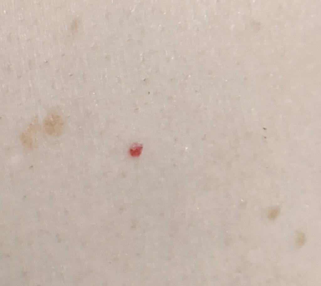 Angioma on the skin