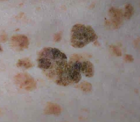 Seborrhoeic keratoses