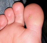 Plantar wart on toe